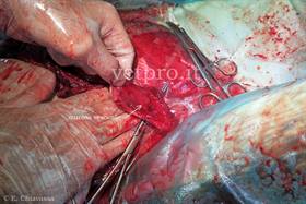 Large intra-abdominal abscess of umbilical origin