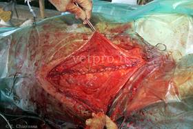 Large intra-abdominal abscess of umbilical origin