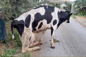 Rottura bilaterale completa del gastrocnemio