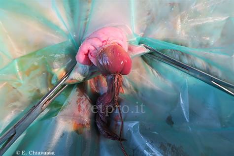 Removal of persintent umbilical cord